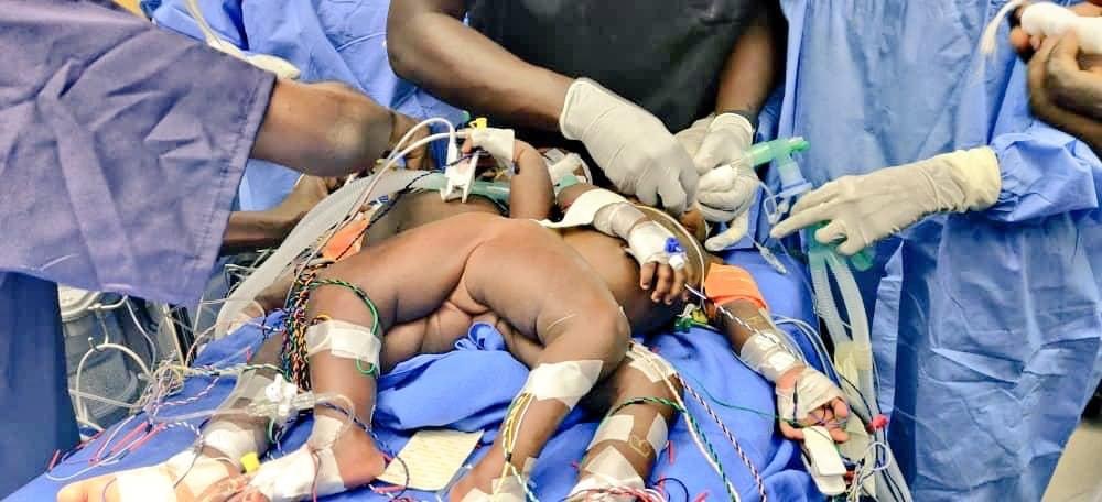 Mulago Specialists separate Siamese twins successfully